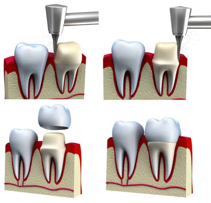 Dental crown installation process, isolated on white Fivecorner