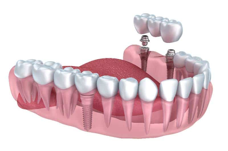 dentalimplants Fivecorner