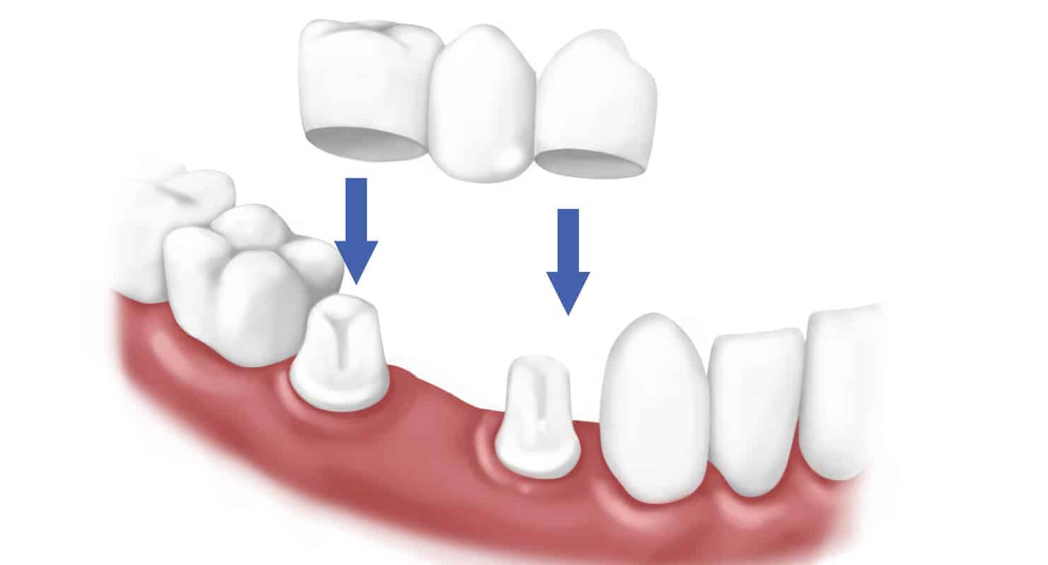 dentalcrown Fivecorner