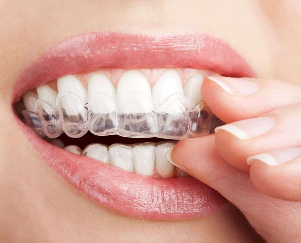 invisalign1contentimage Fivecorner