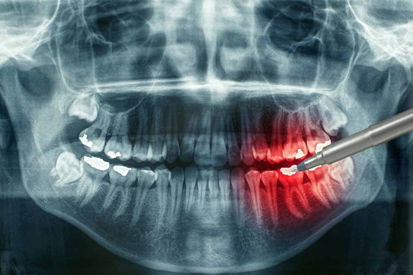digitaldentalxrays image Fivecorner