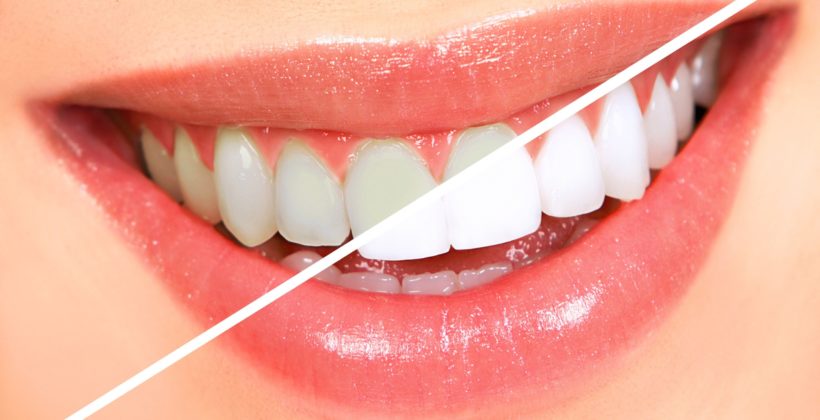 Teeth Whitening at Abbotsford Dental Clinic