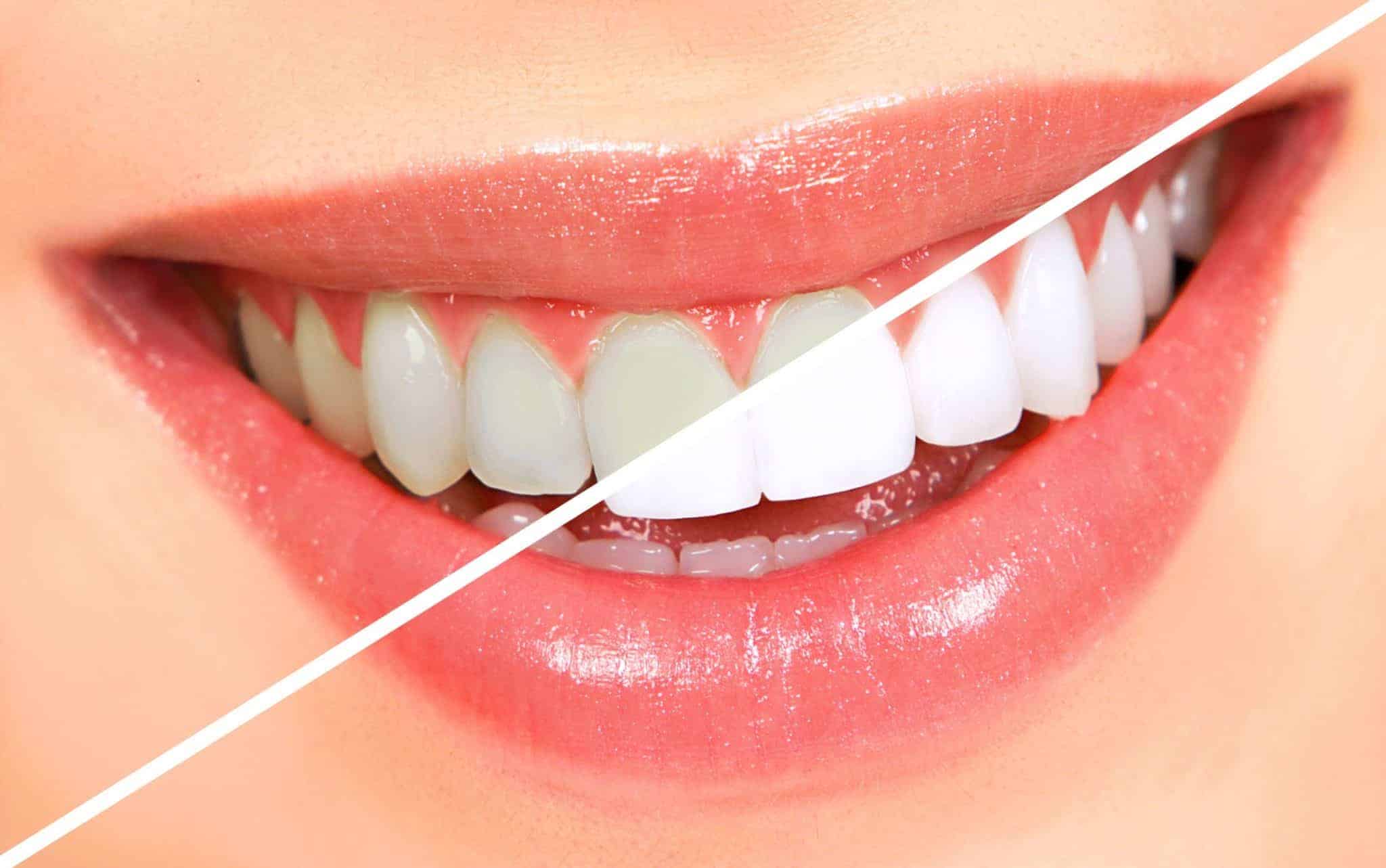 teeth whitening Fivecorner